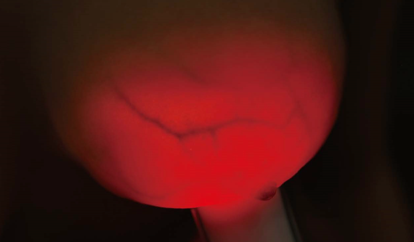 Luminous Breast Pro Series Device - Because Early Detection Saves Lives